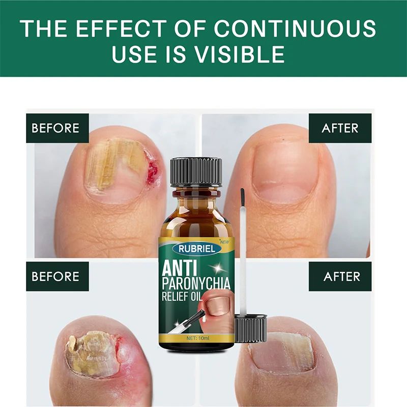 Anti Paronychia Relief Oil ( BUY 1 GET 1 FREE )