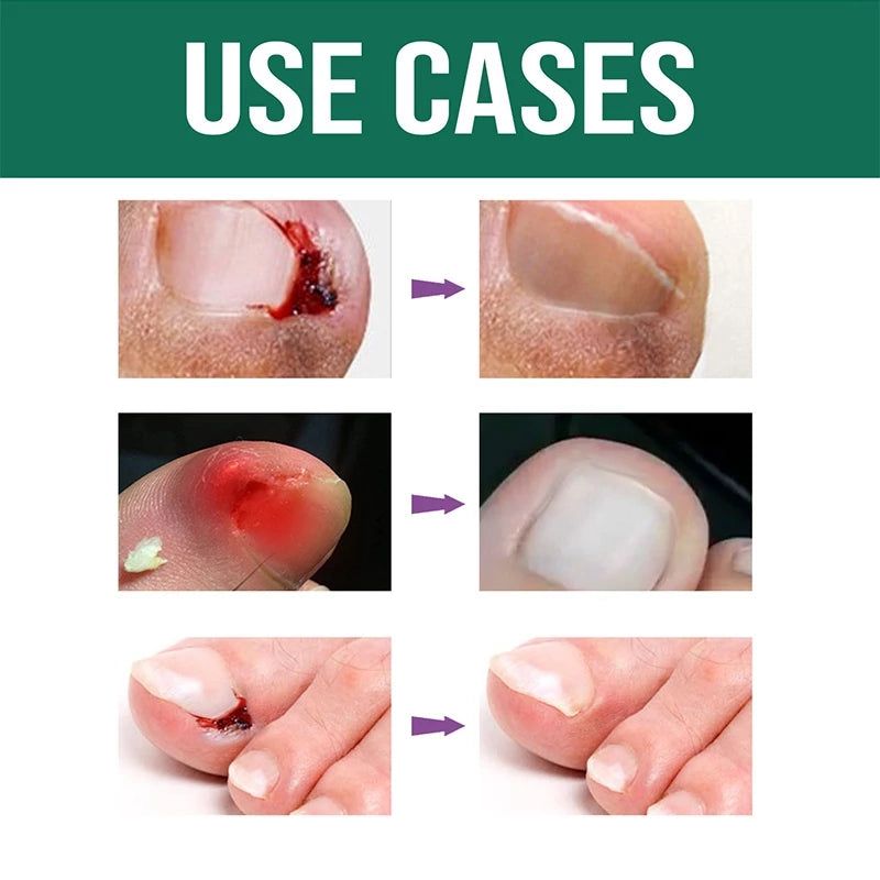 Anti Paronychia Relief Oil ( BUY 1 GET 1 FREE )