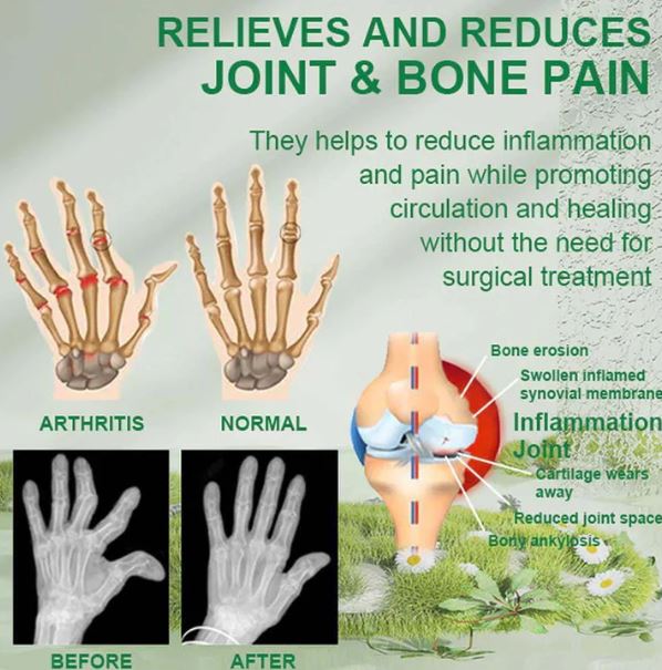 (Pack of 3) BeeTherapy™ #1 Bee Venom Pain Relief Cream | Buy 1 Get 2 Free | ⭐️⭐️⭐️⭐️ 4.9/5 Reviews